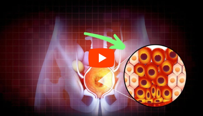 Prostate enlargement treatment illustration